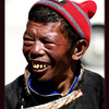 Tibetan man in Tingri in need of dental care